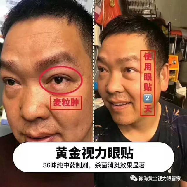 眼睛长霰粒肿-眼睛霰粒肿图片-眼睛麦粒肿手术过程-长