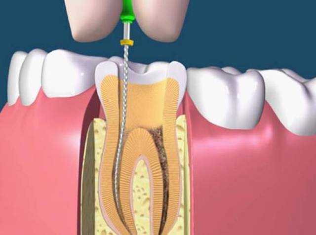 为什么牙齿治疗要抽取牙神经?