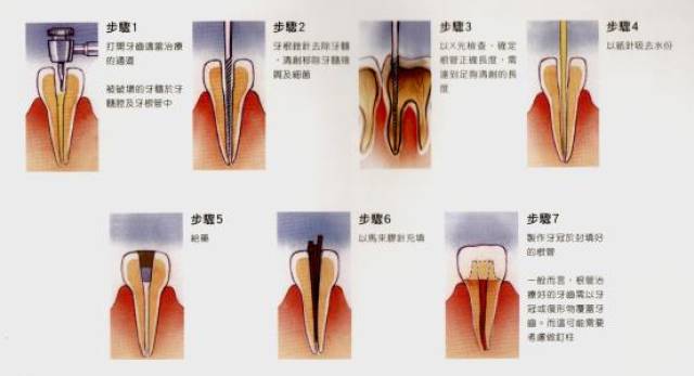问:根管治疗术适应于哪些牙齿疾病?