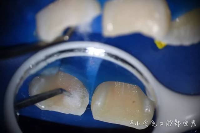 年轻恒牙活髓切断术(显微镜下)