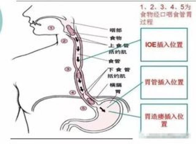 【康复医学科】拒绝胃造瘘,告别鼻饲管---吞咽障碍患者的福音