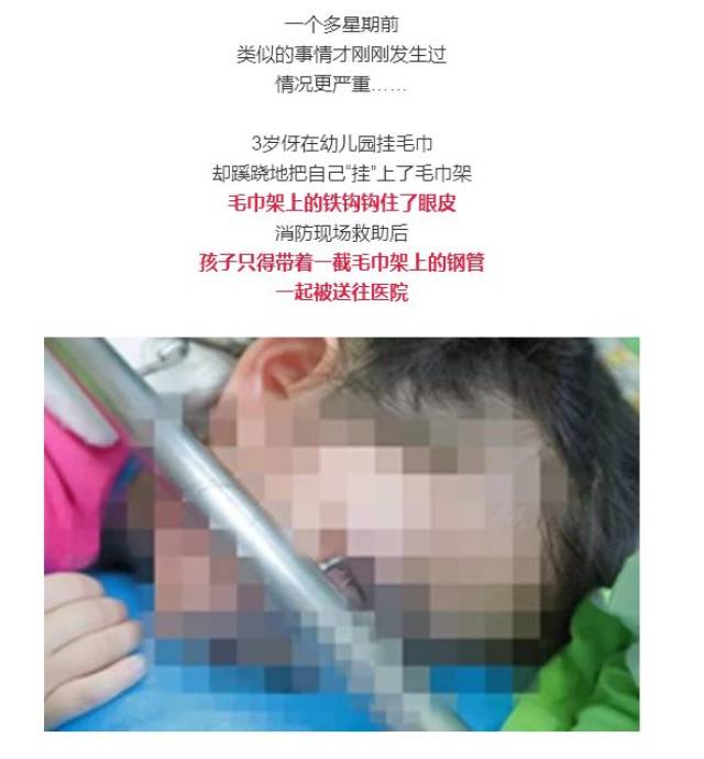 3岁女娃被铁钩戳进眼睛,带着一截钢管送医!