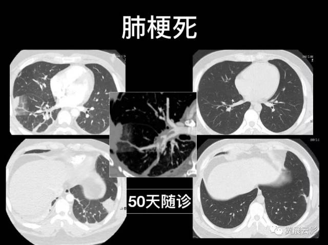 【经典回顾】肺栓塞影像诊断与鉴别