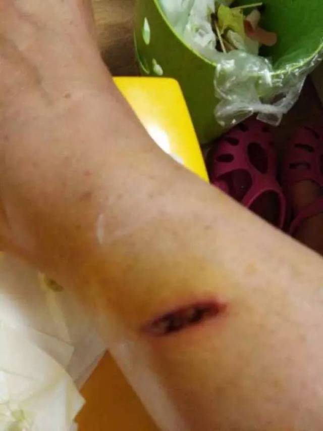 漯河:啤酒瓶爆炸女子被划伤,索赔需要"揭伤疤"开证明