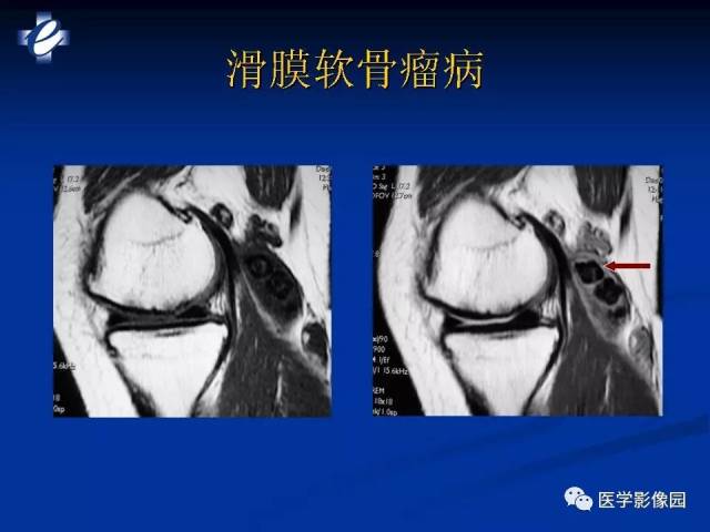 mri软组织肿瘤的影像诊断 影像天地