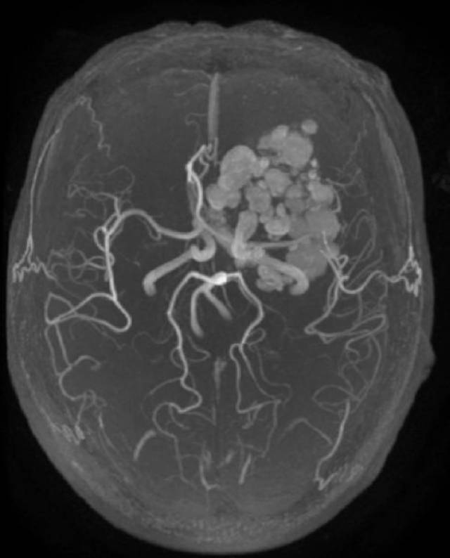 无症状颅内巨大海绵状血管瘤一例----浙二神外周刊(第152期)