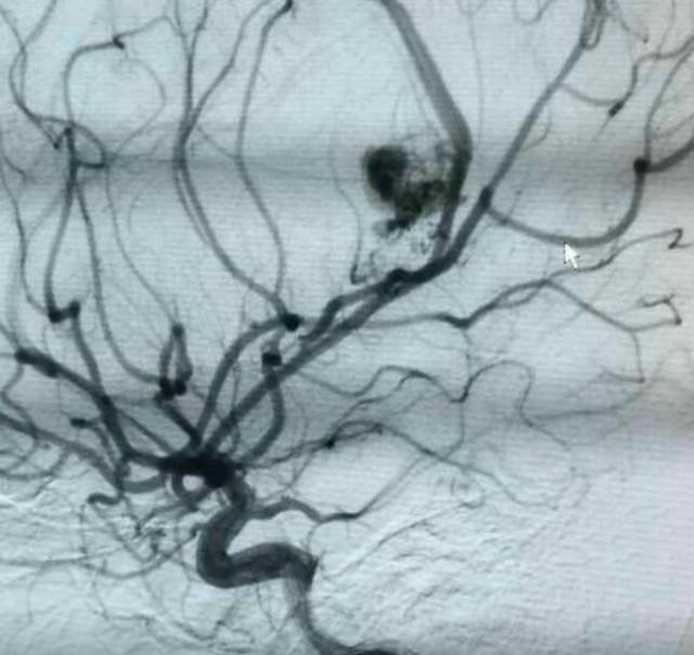 14岁少女脑血管畸形破裂出血,医护人员奋战24小时成功