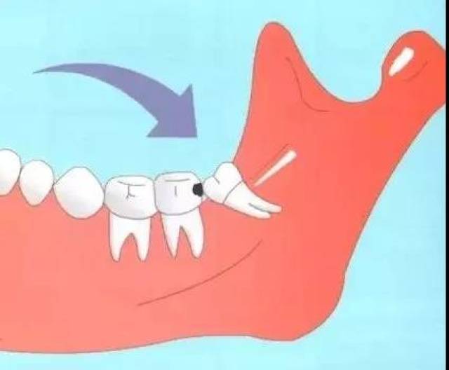 天价阻生牙?--揭秘阻生牙身价为啥这么高!