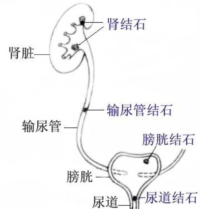尿结石是一个统称,按部位不同,可分为肾结石,输尿管结石和膀胱结石.