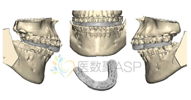 【正颌案例】下颌后缩如何解决?数字化技术辅助正颌手术