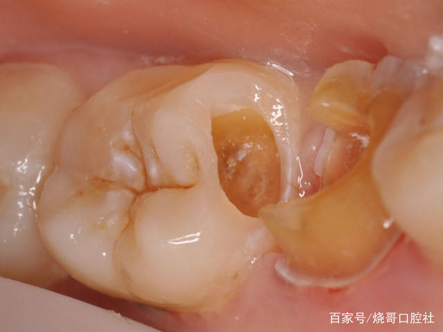 1,其实牙痛有分自发疼和被动疼,前者比如牙髓炎自主疼痛强烈,喝冰水