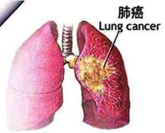 网络图 不抽烟,常锻炼 她们却出肺癌 这家单位在闽南地区,今年4