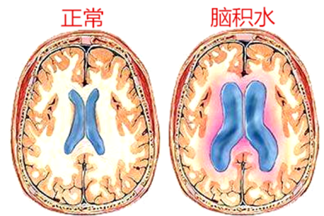 头大≠聪明?脑积水早期症状有哪些