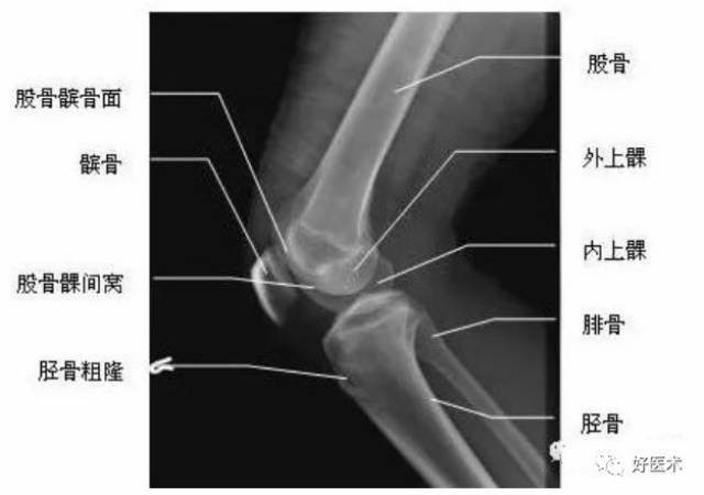 超详细的膝关节x线解剖及测量,基础必备!