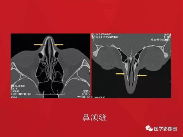 鼻骨骨折影像学诊断与鉴别