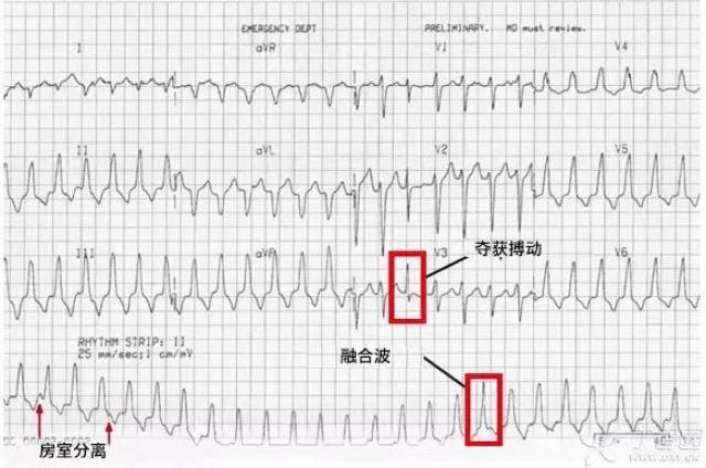 遇到心动过速即心率>100 次/分,首先要看节律是否规整,然后看 qrs 波