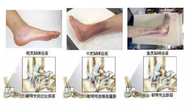 涨知识运动崴脚怎么办点这里了解一下
