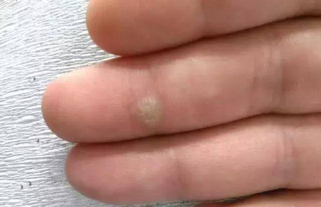 角质增生 搜狐网