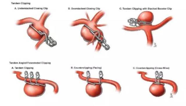 (日本教授使用动脉瘤夹组合技术非常有趣,不过没找到特别清楚的图片