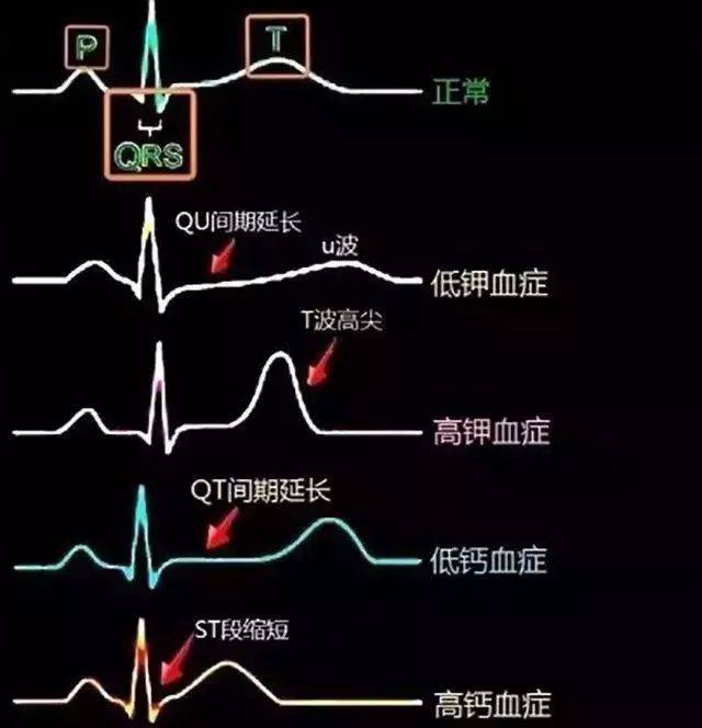 心梗心电图改变