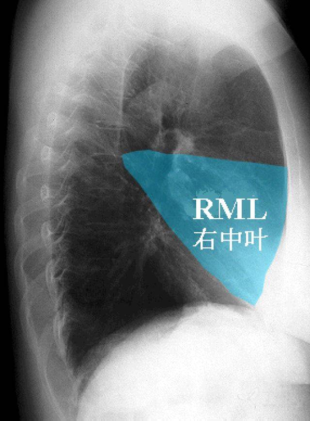秒懂胸片!扒一扒胸片的基础知识