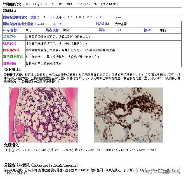 扑朔迷离的经典型套细胞淋巴瘤