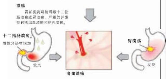 但也有少数患者不会出现这种症状,而是会直接出现穿孔,出血,幽门梗阻