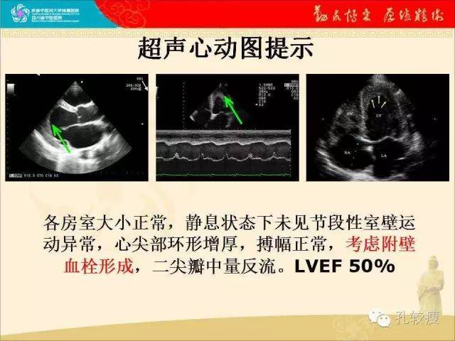 超声心动图检查提示左心室心尖处大量血栓形成(箭头) 心尖四腔心切面