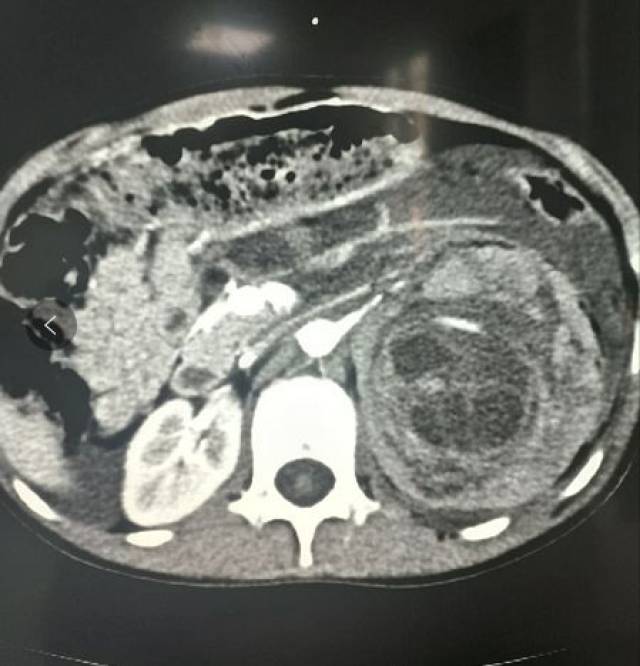 ct提示:左肾破裂伤