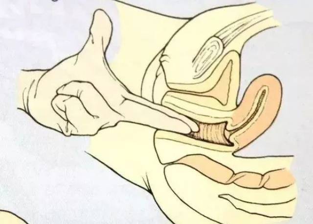 顺产"开十指",真要把10个手指塞进去才能生吗?