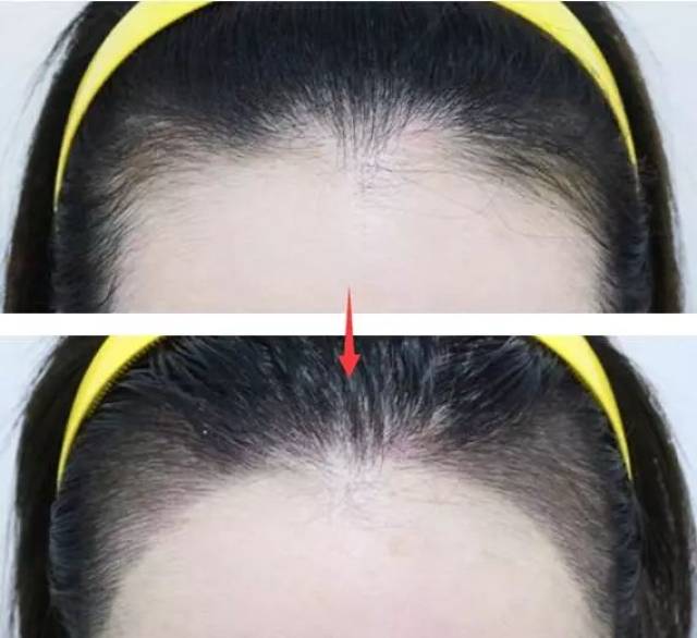 从你自身的后颈处提取毛囊单体移植到你的发际线处,适合发际线靠后