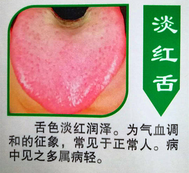 淡红色,正常舌苔,就算病中也属于轻病