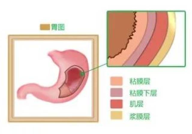 "十人九胃",长期患有慢性胃炎,到底会不会癌变?