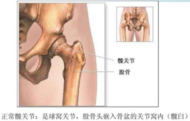臀部通常被称为球窝关节,因为大腿骨的球状顶部在骨盆中的杯状空间内