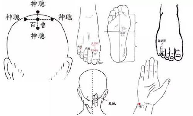 取穴:四神聪,行间,足窍阴,风池,神门