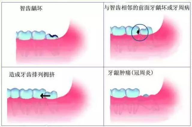 长了智齿一定要拔吗?