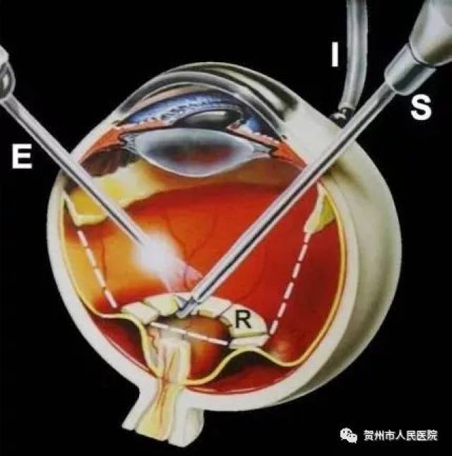 眼疾再也不用跑外地!我院成功开展贺州首例眼后段玻璃体切割手术