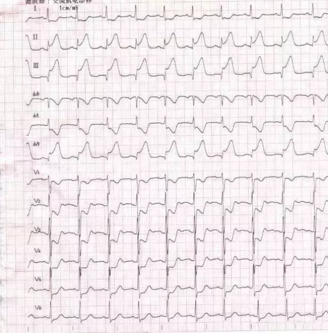 5种致命疾病心电图,做医生的不能不知!