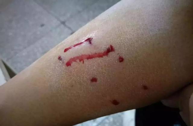 惨!半岁宝宝被两条大狗叼走一顿乱咬…附郑州市狂犬疫苗接种点地址
