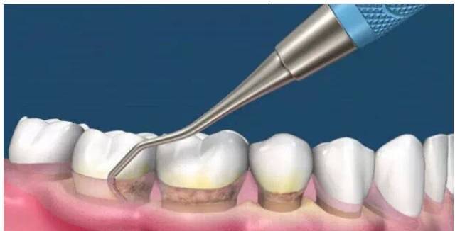 洗牙vs龈下刮治,到底啥区别?