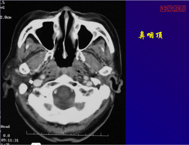 鼻咽癌的ct诊断