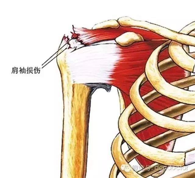 杨华静到了医院一检查才知道,自己的右肩是肩袖损伤肌腱已经撕裂,医院