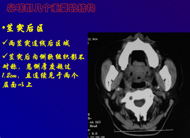 鼻咽癌的ct诊断