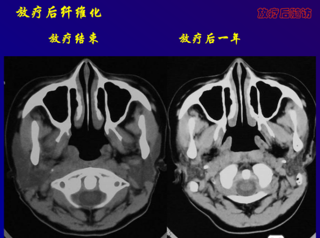 鼻咽癌的ct诊断