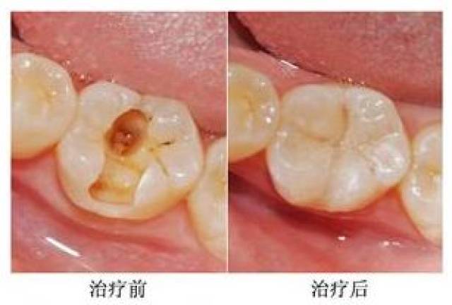 补牙牙套是怎么固定的 补牙牙套五官科