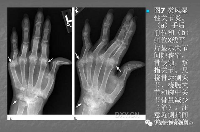 关节炎的x线评价