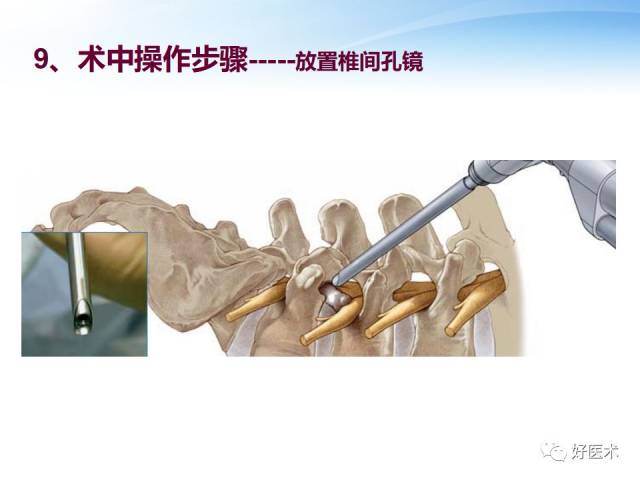 椎间孔镜技术的操作技巧及要点