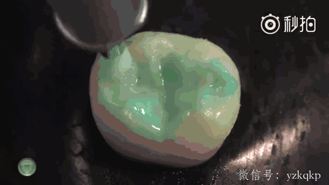 家长还可以提前在家让孩子认识窝沟封闭的过程,其实就是