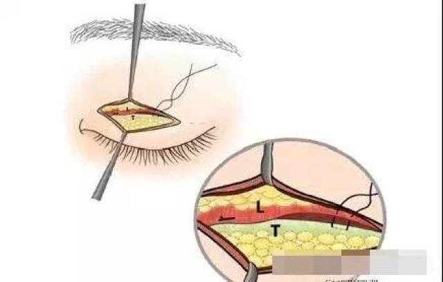 干货| 缝线配合切开法双眼皮新技术介绍