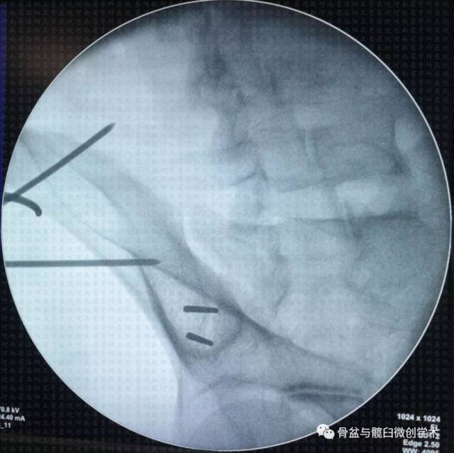 定位并预留骶髂螺钉置入空间